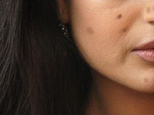 Пигментные пятна на лице – причина и лечение