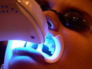 Лазерное отбеливание зубов, отзывы и противопоказания
